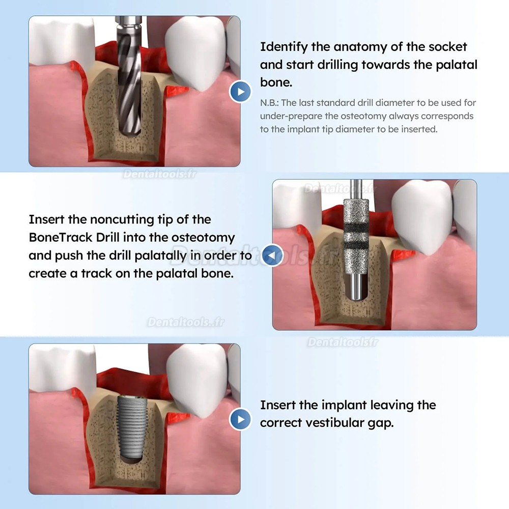 FG7604 kit de 4 forets de guidage pour positionnement et correction cervicale (implant dentaire)
